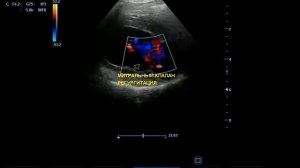 Митральный клапан. Регургитация.