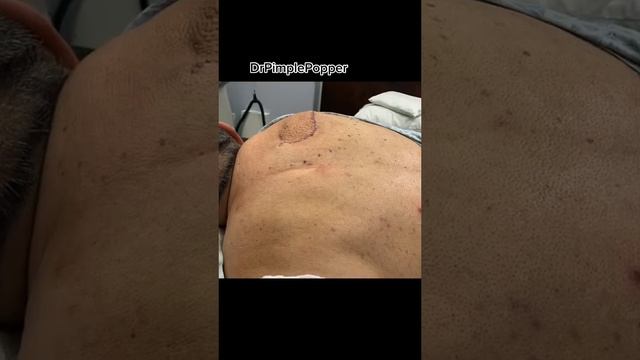 What Would You Rate My Technique? Dr Pimple Popper #shorts смотреть онлайн