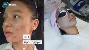 Лазерный КАРБОНОВЫЙ ПИЛИНГ? ДО и ПОСЛЕ!!!