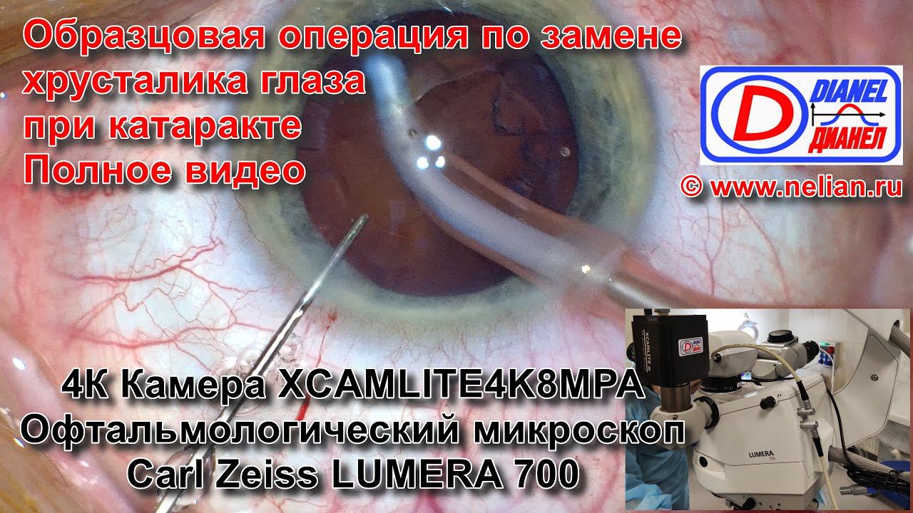 Операция по замене хрусталика глаза при катаракте полностью на камеру офтальмологического микроскопа смотреть онлайн