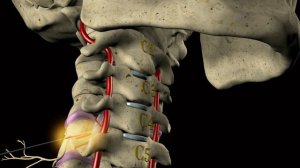 РЧД (Радиочастотная денервация фасеточных нервов)
