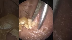 Акне. Черные точки. Вросшие волосы и прыщи. Ушная пробка и сера!