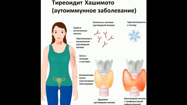 Щитовидная железа - дирижёр всего организма смотреть онлайн