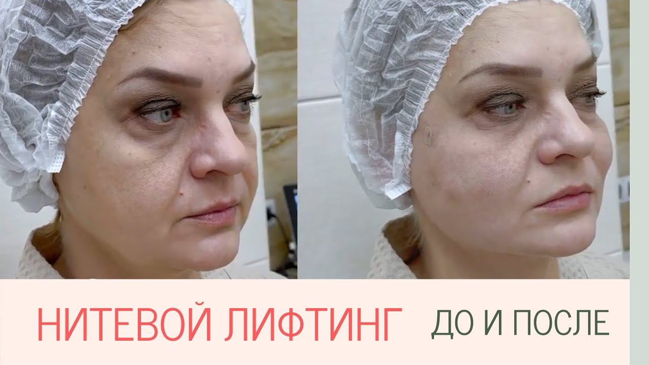 Лифтинг нитями #допосле
