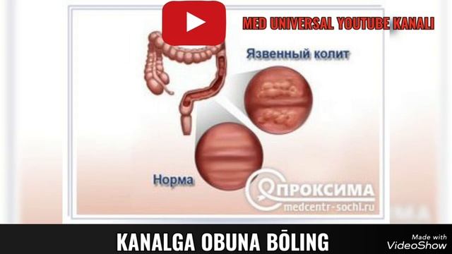 GEMOROY KASALLIGI HAQIDA BATAFSIL MA'LUMOT. YO'G'ON ICHAK KASALLIKLARI HAQIDA MA'LUMOT. KOLIT HAQID