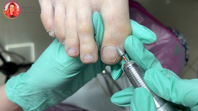 Препаратно-аппаратный педикюр / Средства для педикюра / Фрезы для педикюра