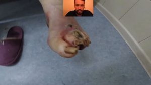 Гангрена стопы. Первые признаки. Влажная? Gangrene. Сахарный диабет.