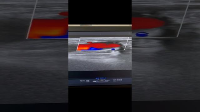 Варикоз малого таза при идеальных венах на ногах. Сосудистый хирург Москва. Узи сосудов. Флеболог смотреть онлайн