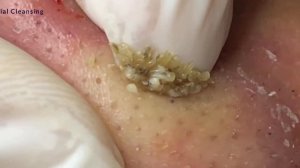 #3 Blackhead Removal  Удаление черных точек