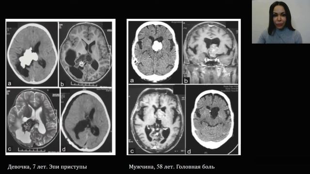 CAPNON | КАЛЬЦИФИЦИРОВАННЫЕ ОБРАЗОВАНИЯ | МРТ | НАТАЛЬЯ МЕДВЕДЕВА | MOSCOW RADIOLOGY TEAM