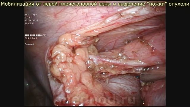 Полностью торакоскопическое удаление опухоли средостения (РНЦХ) смотреть онлайн