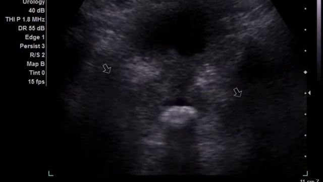 УЗИ ОМТ у мужчины -3.wmv смотреть онлайн