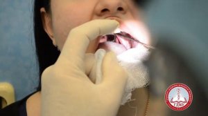 непрямая ларингоскопия