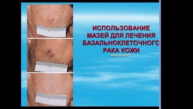 13.50 рак кожи.Меланома смотреть онлайн