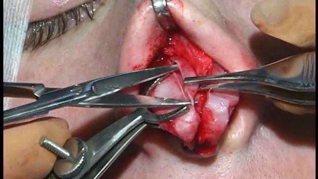 Live Rhinoplasty Video with Dr. Bahman Guyuron смотреть онлайн