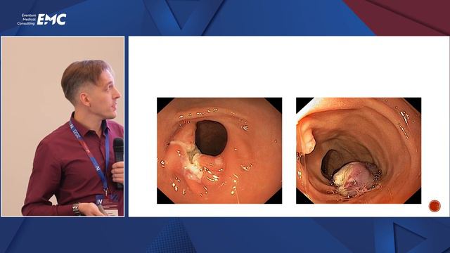 Доклад «Удаление новообразований верхних и нижних отделов желудочно-кишечного тракта у детей» смотреть онлайн