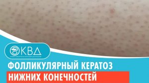 ?? Фолликулярный кератоз нижних конечностей. Клинический случай №623