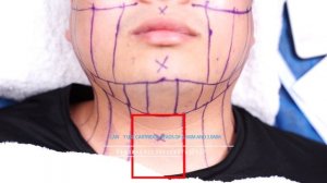 Sincolaser Аппарат 5D смас лифтинг Ulti-max для лифтинга лица