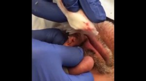 ASMR выдавливание акне, прыщей