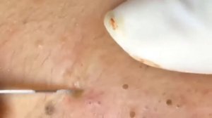 Выдавливание жирных прыщей с лица