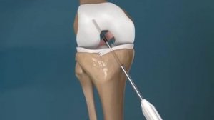 Лечение разрыва передней крестообразной связки колена. Замена ПКС на искусственное сухожилие