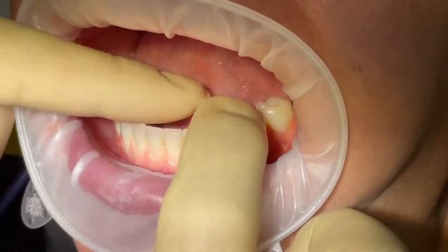 Условно Съёмный протез. Техосмотр. смотреть онлайн