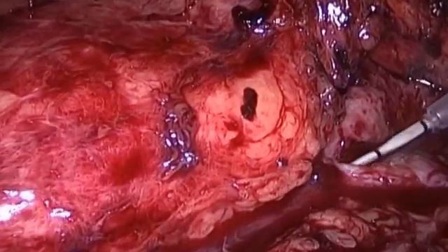 Laparoscopic Pyeloplasty  Лапароскопическая пиелопластика