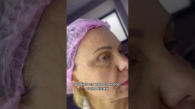 Беспроигрышный способ борьбы с пигментацией смотреть онлайн