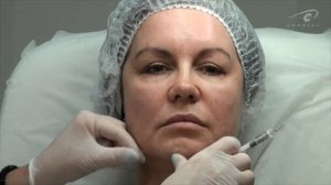 Легко и быстро поднимаем уголки рта - контурная пластика губ Princess.