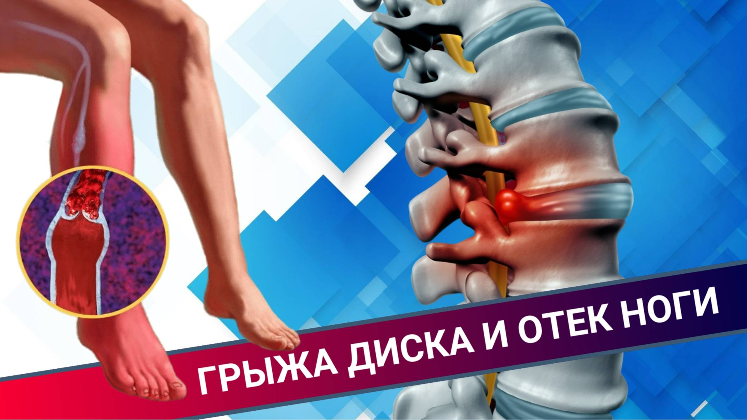ГРЫЖА ДИСКА И ОТЁК НОГИ смотреть онлайн