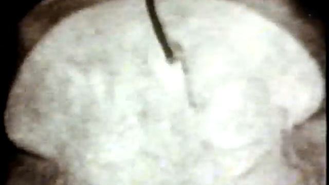 Миома матки, Исследования в гинекологии © hysteromyoma, Research in Gynecology смотреть онлайн