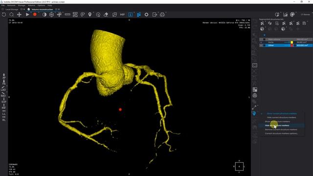 Coronary arteries segmentation in Inobitec DICOM Viewer Pro смотреть онлайн