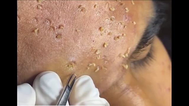 Удаление черных точек 2021 - Remoção de cravo 2021 - Pimple Popping 2021 -Blackhead Removal 2021 смотреть онлайн