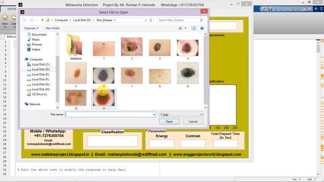 Melanoma Detection Using Image Processing Full Matlab Project Code смотреть онлайн