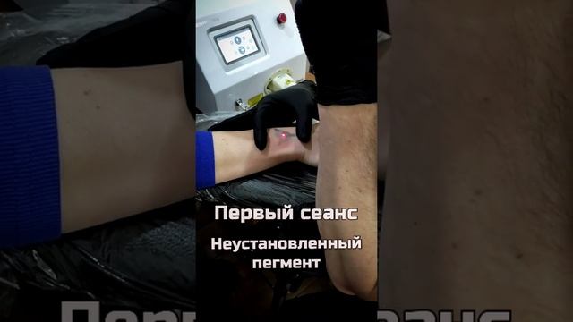 Можно ли материться на сеансе удаления татуировки? смотреть онлайн
