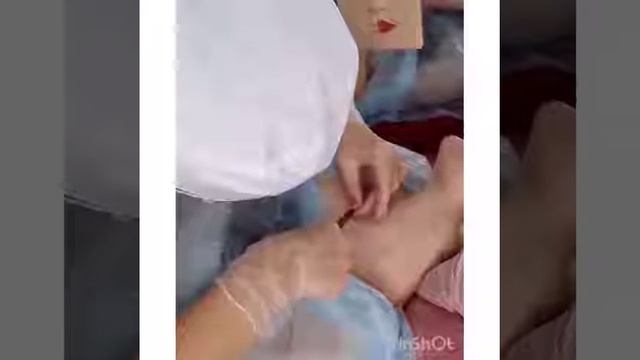 Установка микродермала смотреть онлайн