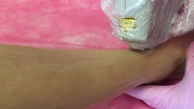 Лазерная эпиляция клиника Multimed смотреть онлайн