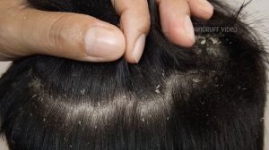 Экстремальное удаление перхоти большими хлопьями #900