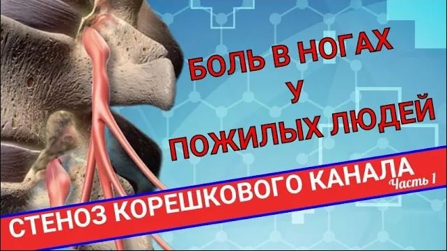 НАРАСТАЮЩАЯ БОЛЬ В НОГАХ. Стеноз корешкового канала (Часть 1) смотреть онлайн