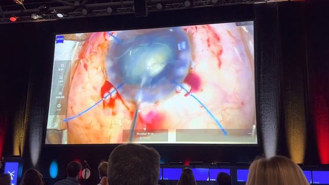 Video symposium of challenging cases ESCRS 2021 смотреть онлайн
