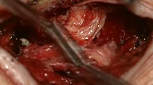 Микрохирургическая дискэктомия в сегменте L4-L5