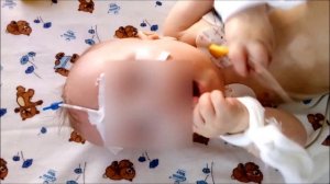 Миоклонус