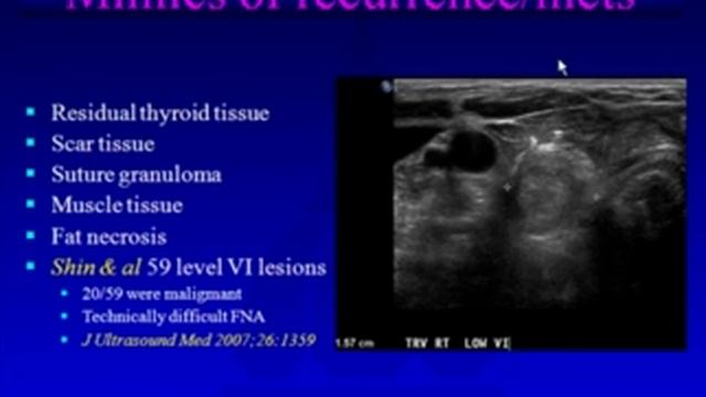 Role of Neck Sonography After Total Thyroidectomy for Differentiated Thyroid Cancer смотреть онлайн