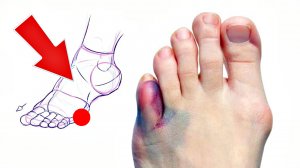 Как отличить перелом мизинца от ушиба на ноге? Как распознать перелом мизинца на ноге.