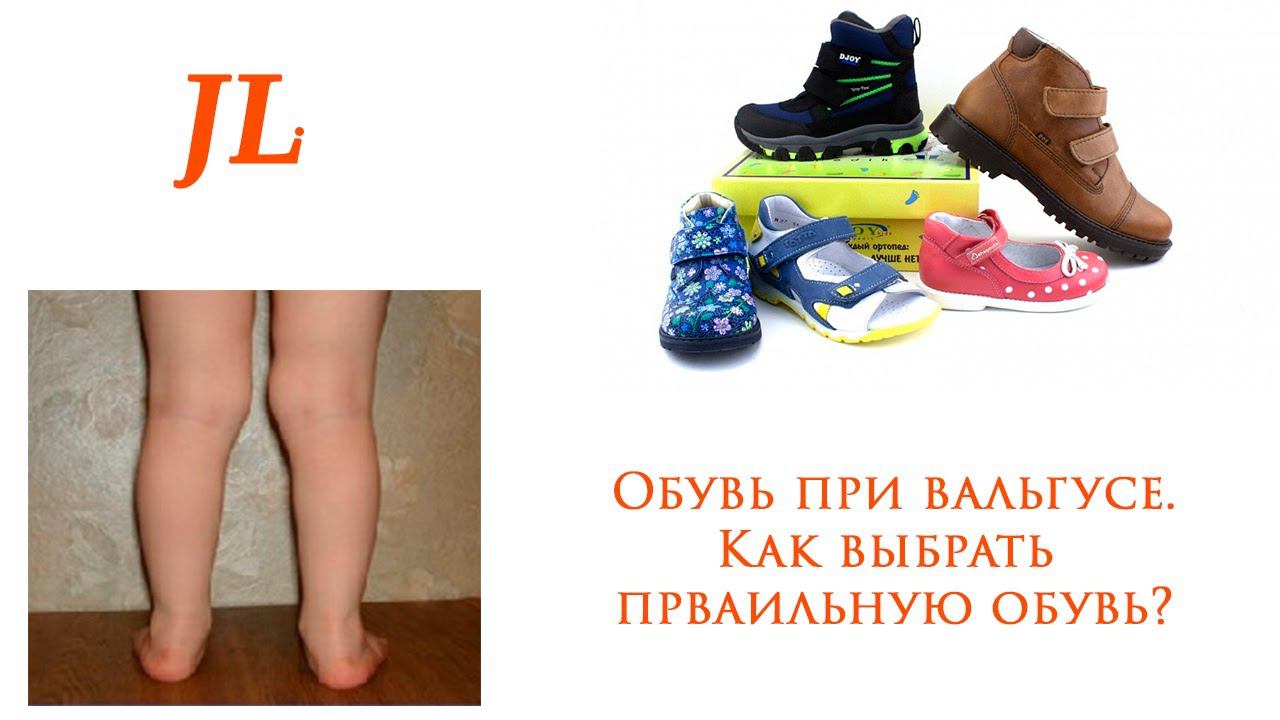 Вальгус у ребёнка. Обувь. Как выбрать 