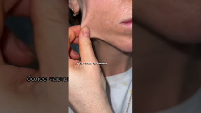 3 признака дисплазии !#дисплазия смотреть онлайн