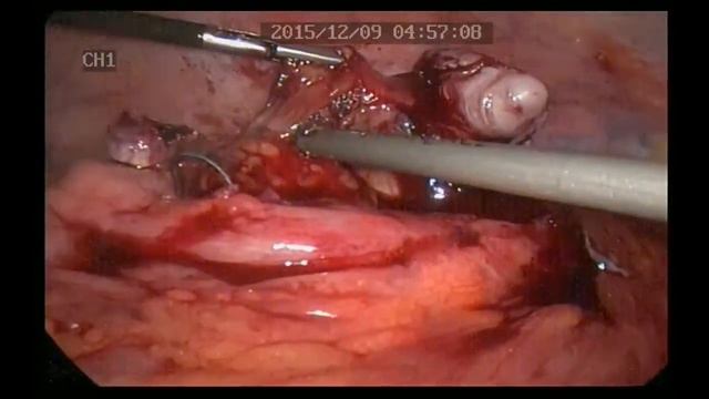 Лапароскопическая аппендэктомия у больной через 2 месяца после консервативного лечения аппендикуляр смотреть онлайн