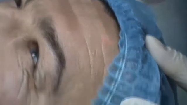 СО2 лазер Космопульс 2 (лазерная шлифовка)