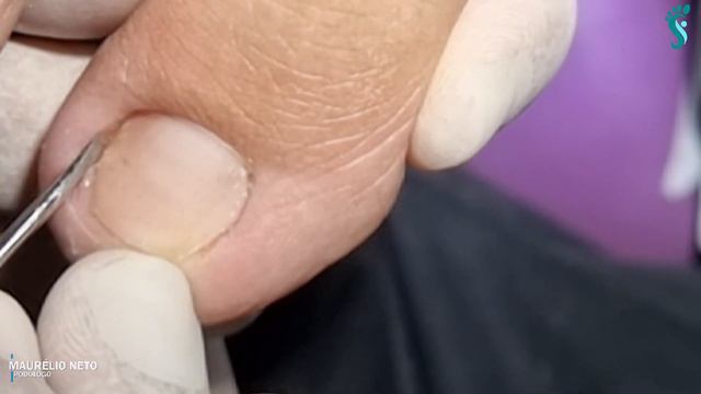 UM CORTE ARREDONDADO QUE ACABOU ENCRAVANDO . E AGORA ?? смотреть онлайн