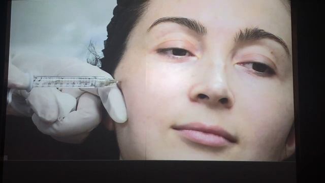 БОТОКС/ ЮВИДЕРМ / ПРАКТИКА/ РАЗУМОВСКАЯ. часть 2 смотреть онлайн